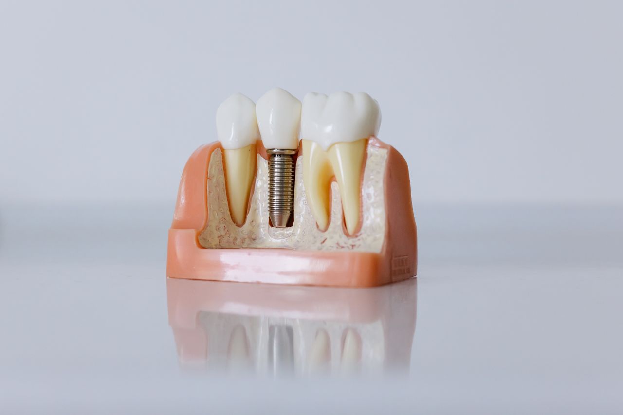 Implant Dentistry in Plymouth